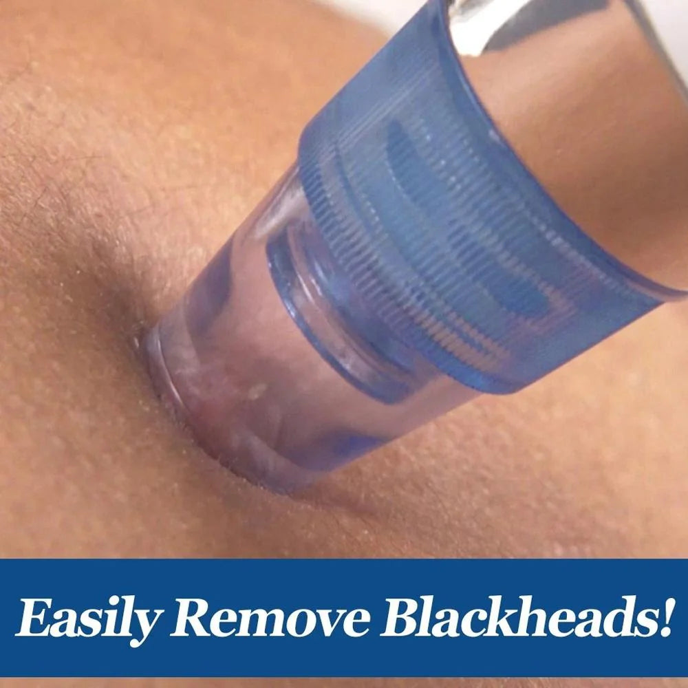 4-in-1 Blackhead Remover